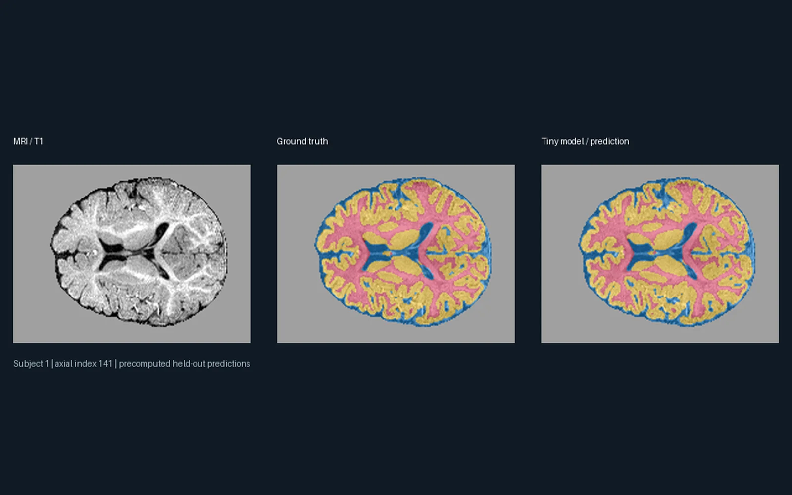 An infant brain MRI slice, its ground-truth segmentation and the compact model’s prediction, side by side.